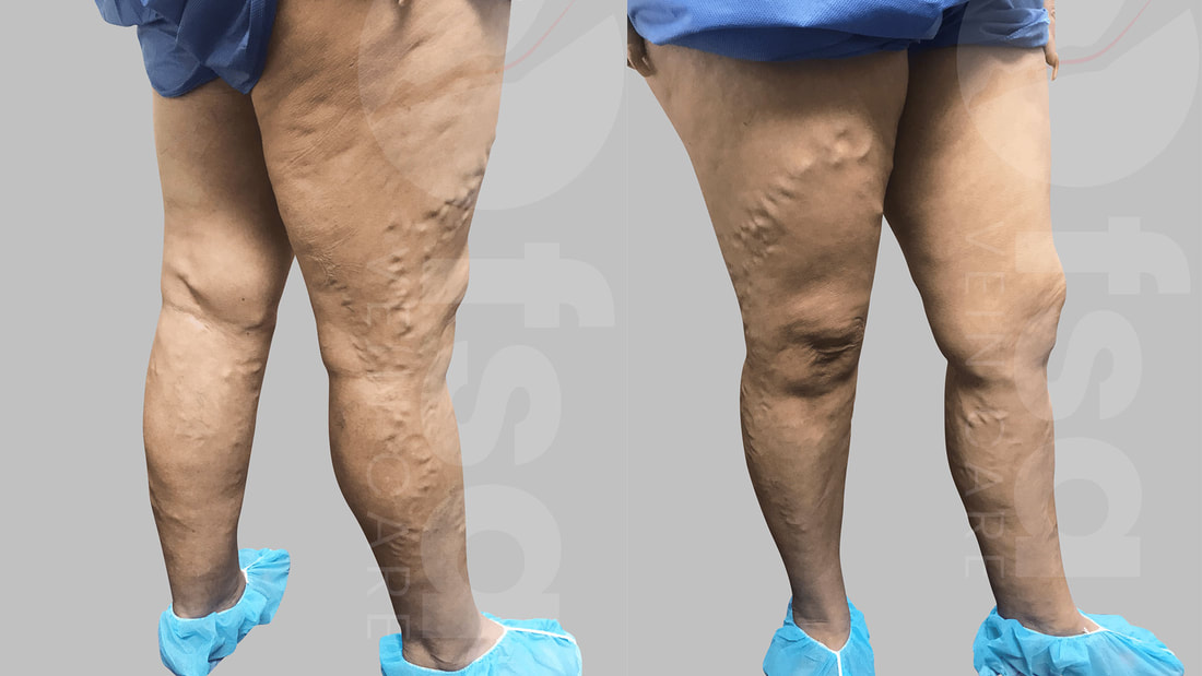 Varicose Vein Treatment To Remove Varicose Veins in Spring Hill, FL